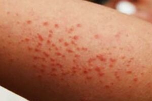 Sarampión se expande por todo México; piden vacunarse